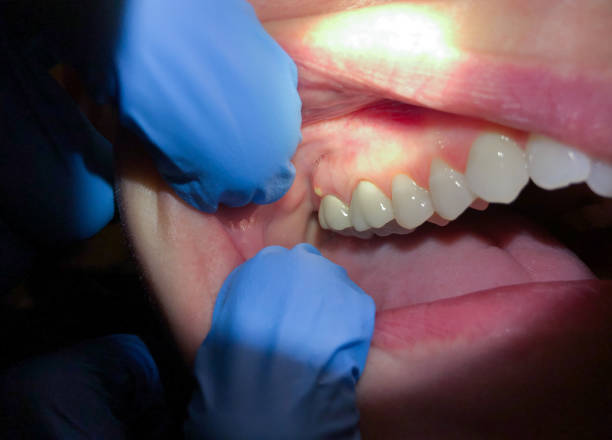 Best Emergency Treatment for Toothache in Hermann, MO